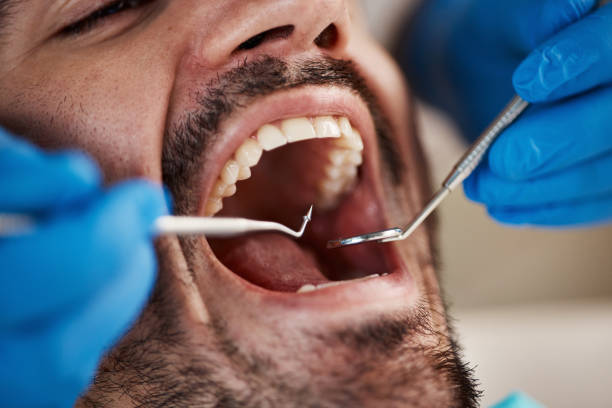 Best Emergency Tooth Extraction in Iowa Colony, TX