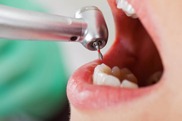 Best Emergency Treatment for Dental Infections or Abscesses in Iowa Colony, TX